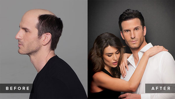 rx-hair-before-after-009